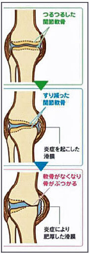 関節軟骨がいたんできた時の症状です。